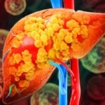 gordura-no-figado:-saiba-quais-sao-os-sintomas-da-esteatose-hepatica