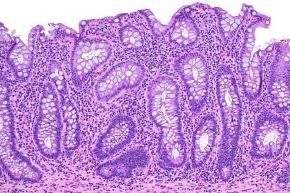 doencas-inflamatorias-intestinais-nao-sao-mais-raras-e-exigem-atencao