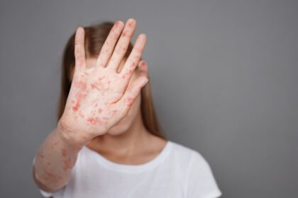 saude-alerta-para-casos-de-sarampo-e-queda-na-vacinacao-no-brasil