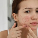 fim-da-acne?-vacinas-estao-a-caminho!