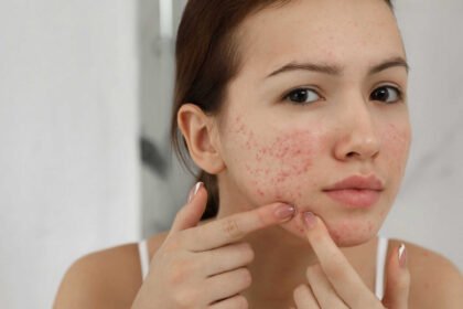 fim-da-acne?-vacinas-estao-a-caminho!