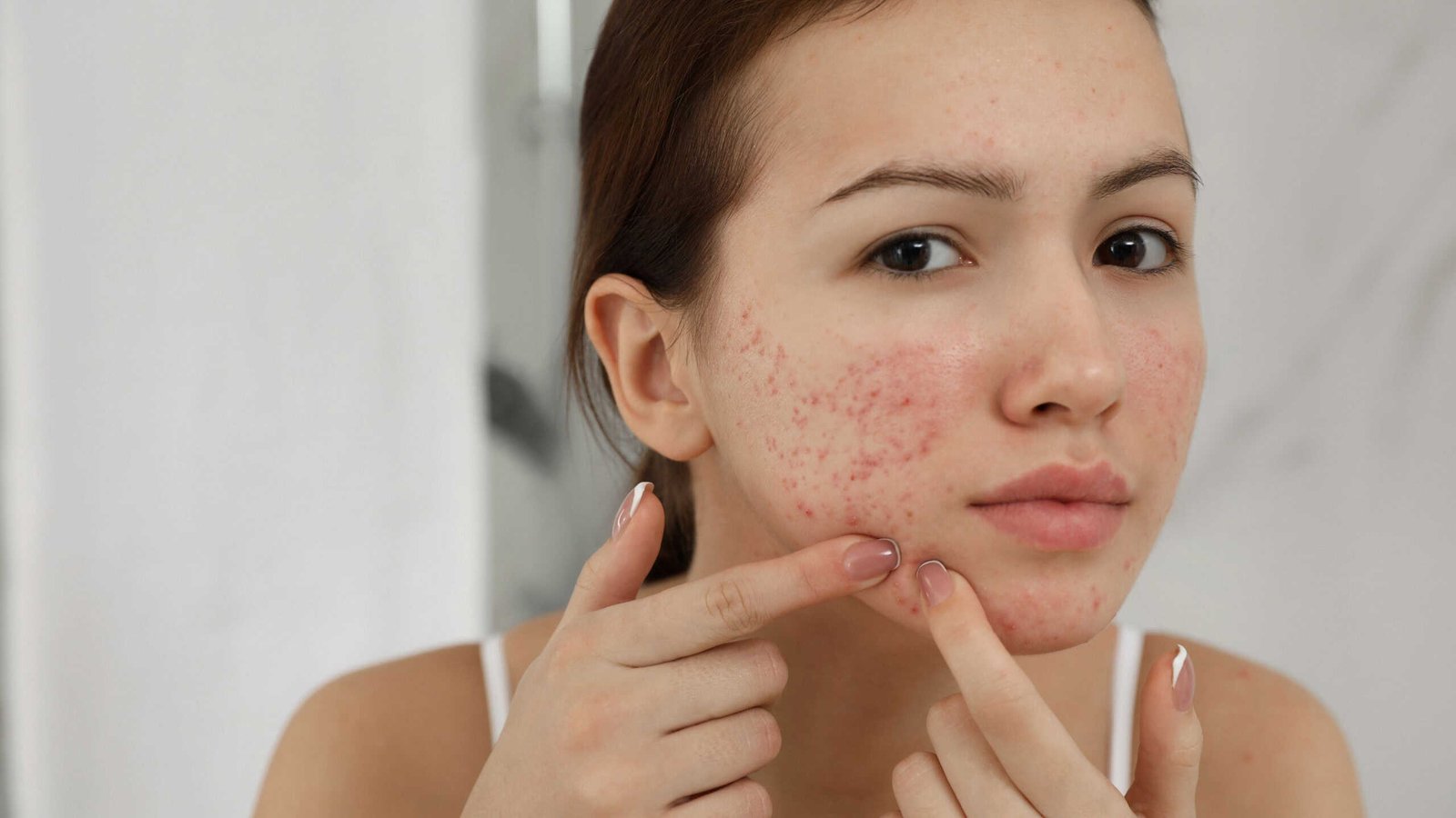 fim-da-acne?-vacinas-estao-a-caminho!