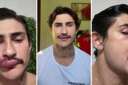 triangulo-da-morte:-caso-de-influenciador-mostra-perigo-de-apertar-espinhas-|-cnn-brasil