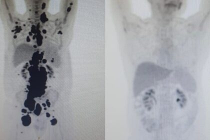 entenda-a-diferenca-entre-cura-do-cancer-e-remissao-da-doenca-|-g1