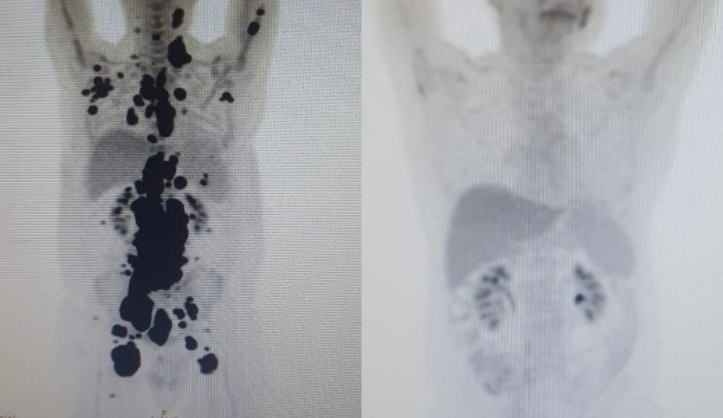 entenda-a-diferenca-entre-cura-do-cancer-e-remissao-da-doenca-|-g1