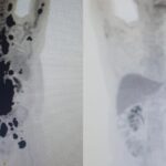 paciente-com-cancer-ha-13-anos-tem-remissao-completa-em-sp-em-um-mes-apos-terapia-celular-em-estudo-na-rede-publica-|-g1