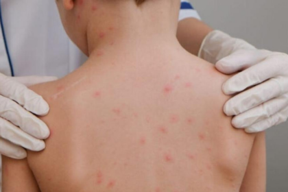 casos-confirmados-de-meningite-caem-35%-no-acre-em-2026